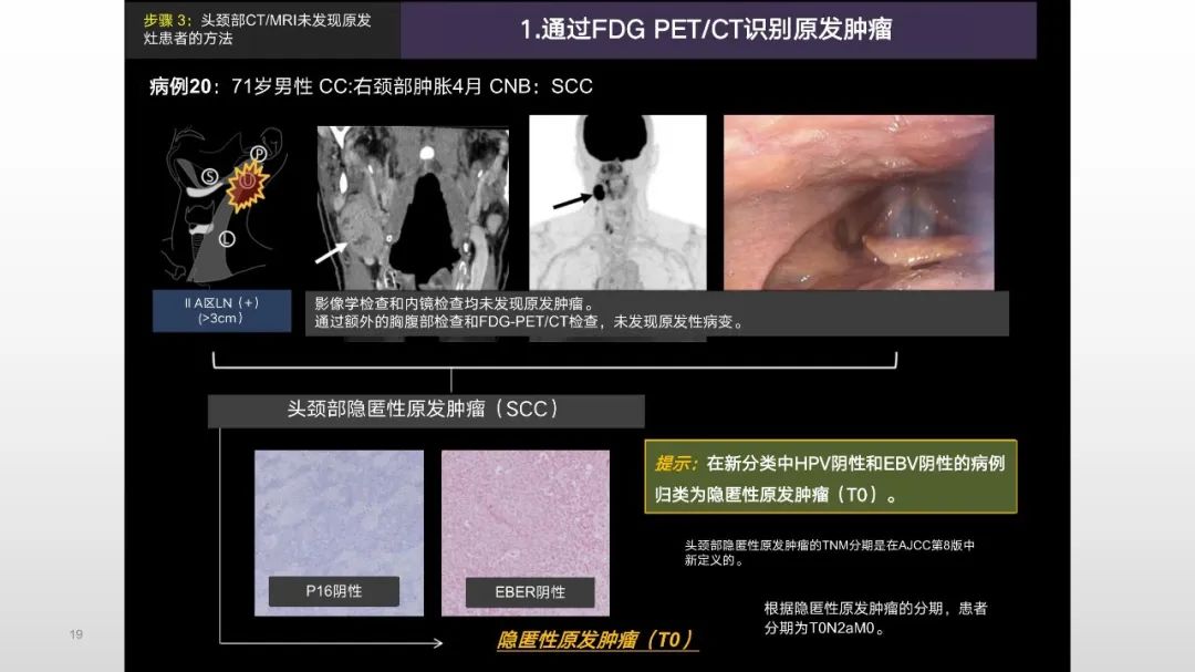 影像PPT - 【PPT】原发肿瘤在哪里？不明原发肿瘤颈部淋巴结转移的影像学检查方法-17