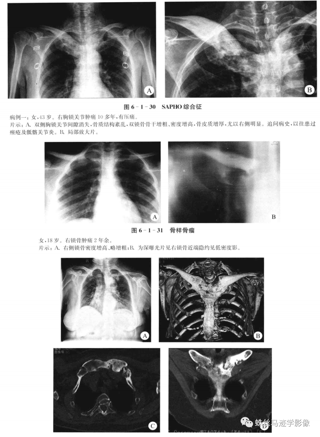 影像PPT - SAPHO综合征-1 影像PPT - SAPHO综合征-1