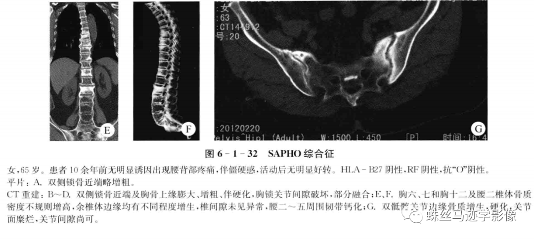 影像PPT - SAPHO综合征-2 影像PPT - SAPHO综合征-2