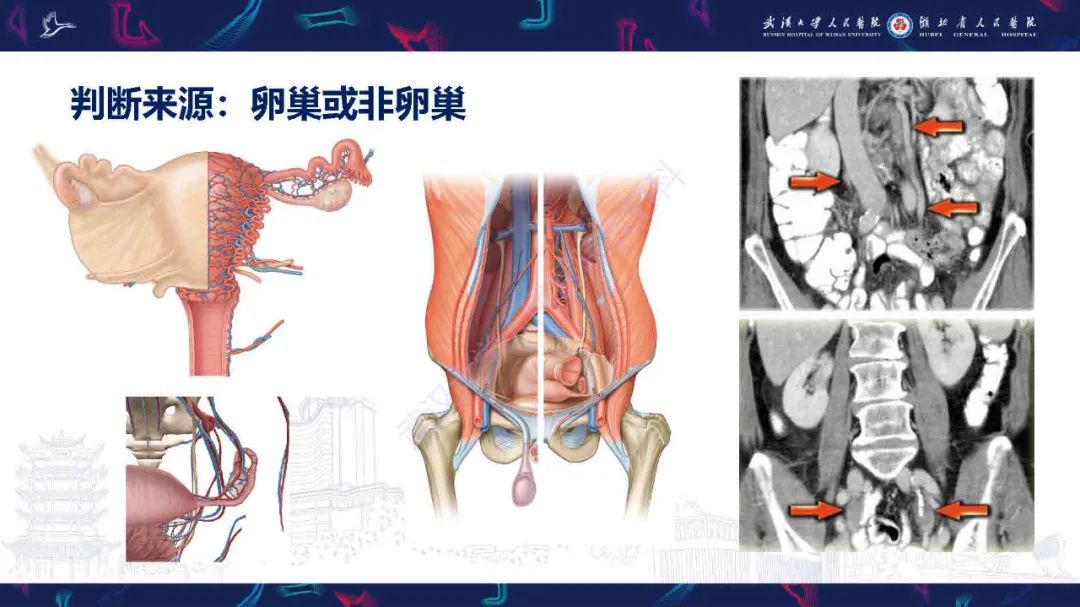 影像PPT - 【PPT】卵巢囊性病变影像诊断思路-6