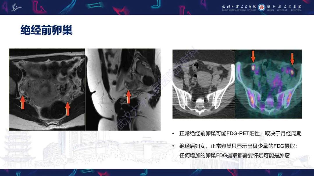 影像PPT - 【PPT】卵巢囊性病变影像诊断思路-9