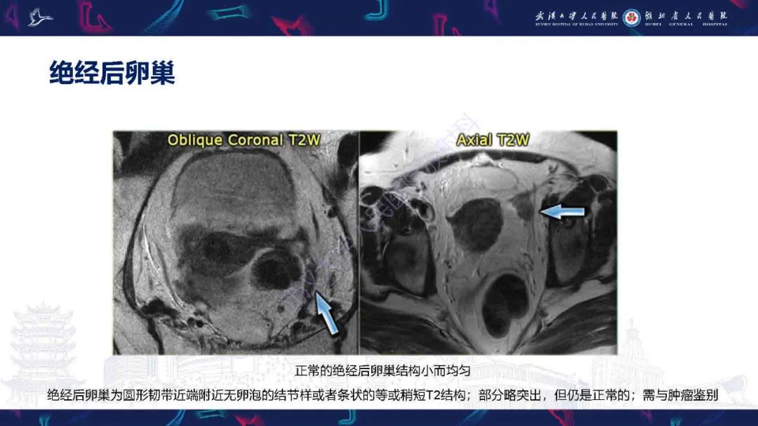 影像PPT - 【PPT】卵巢囊性病变影像诊断思路-10