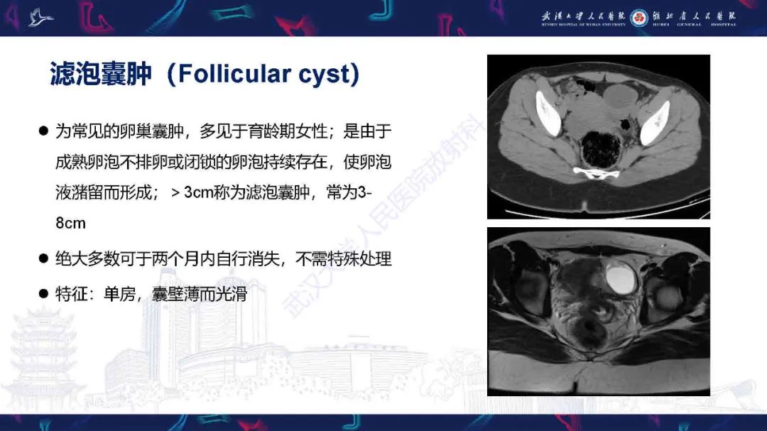 影像PPT - 【PPT】卵巢囊性病变影像诊断思路-13