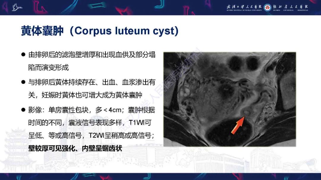 影像PPT - 【PPT】卵巢囊性病变影像诊断思路-14