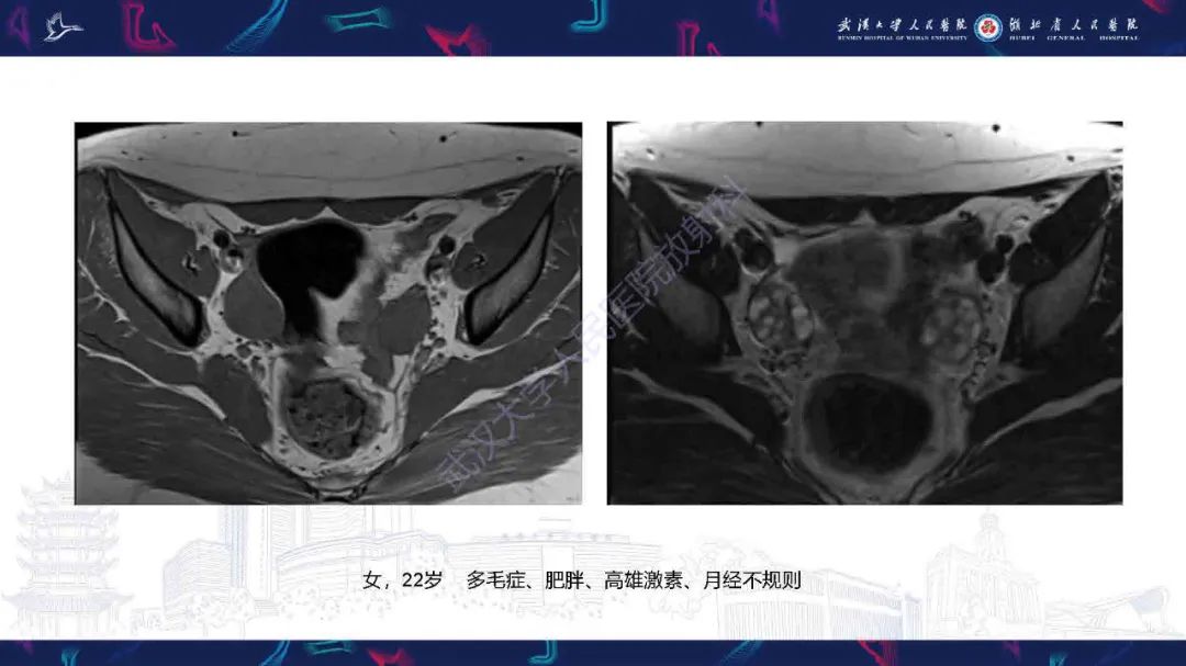 影像PPT - 【PPT】卵巢囊性病变影像诊断思路-18