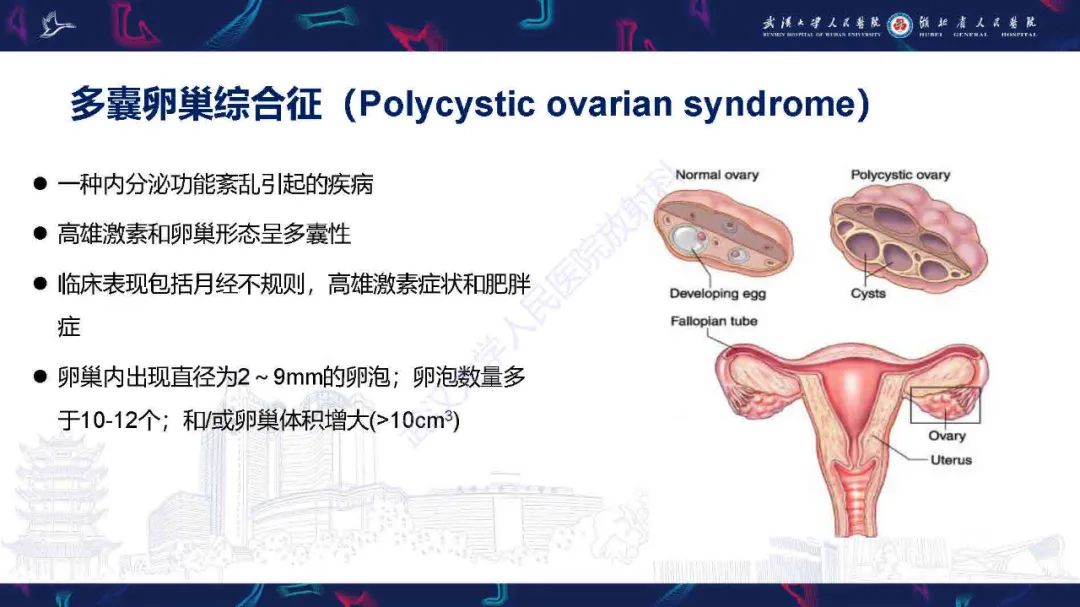 影像PPT - 【PPT】卵巢囊性病变影像诊断思路-17