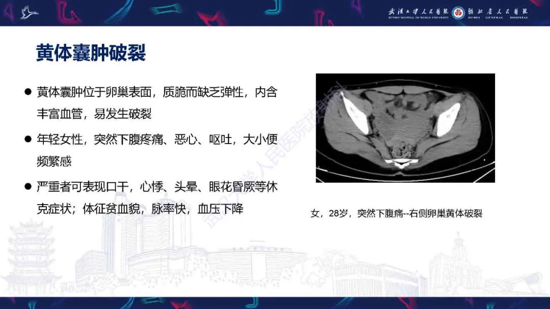影像PPT - 【PPT】卵巢囊性病变影像诊断思路-22
