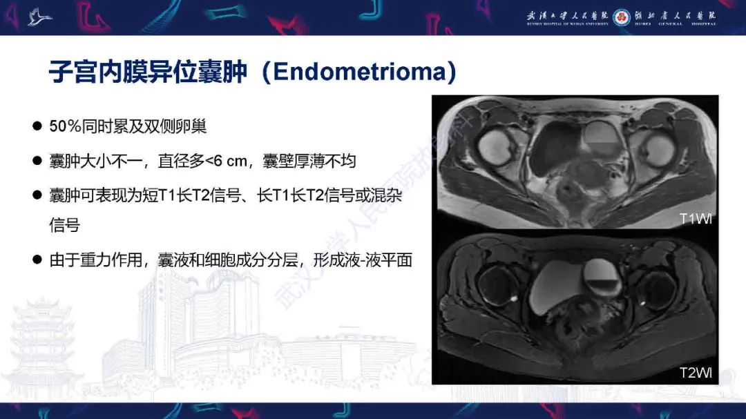 影像PPT - 【PPT】卵巢囊性病变影像诊断思路-24