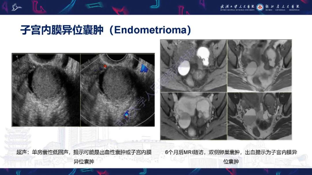 影像PPT - 【PPT】卵巢囊性病变影像诊断思路-25