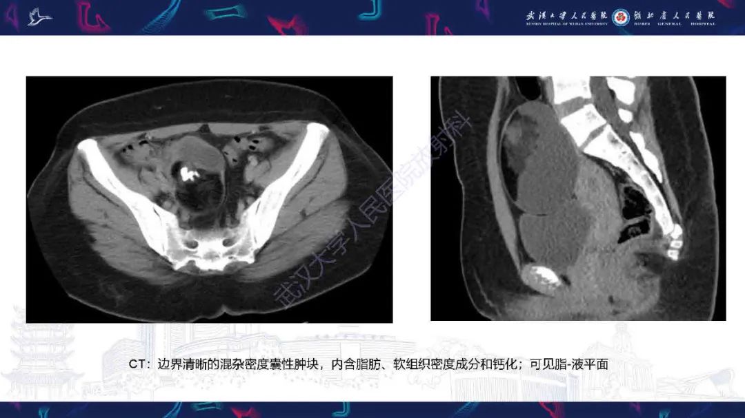 影像PPT - 【PPT】卵巢囊性病变影像诊断思路-27