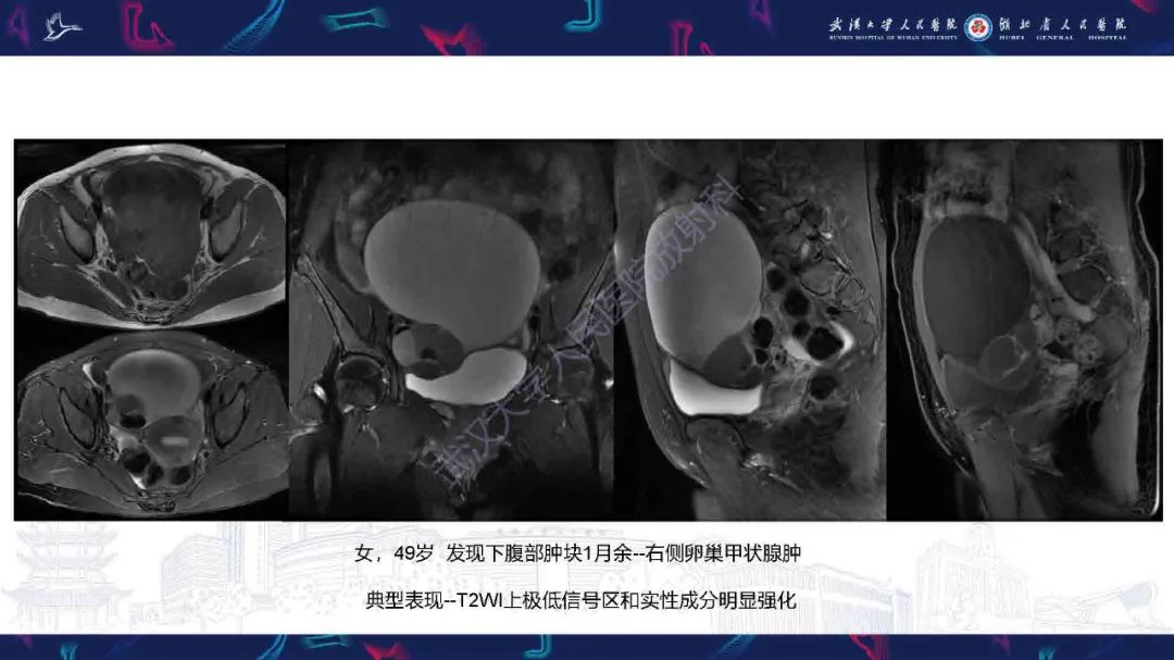 影像PPT - 【PPT】卵巢囊性病变影像诊断思路-28