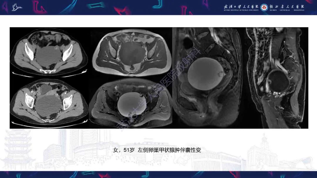 影像PPT - 【PPT】卵巢囊性病变影像诊断思路-29
