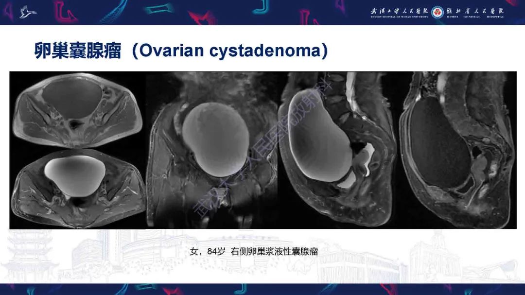 影像PPT - 【PPT】卵巢囊性病变影像诊断思路-31