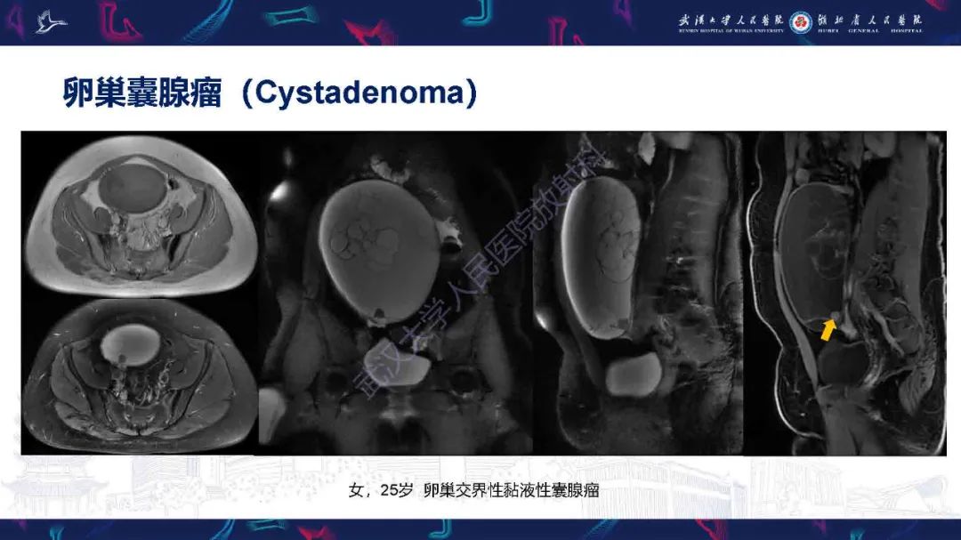影像PPT - 【PPT】卵巢囊性病变影像诊断思路-32