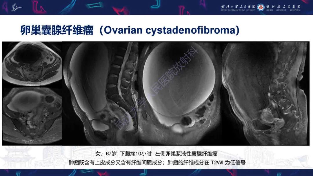影像PPT - 【PPT】卵巢囊性病变影像诊断思路-33