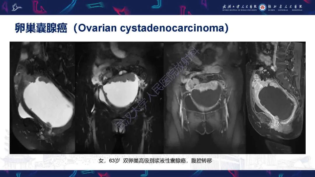 影像PPT - 【PPT】卵巢囊性病变影像诊断思路-34
