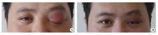 影像PPT - 眼眶蜂窝织炎和眶周脓肿影像诊断-2 影像PPT - 眼眶蜂窝织炎和眶周脓肿影像诊断-2