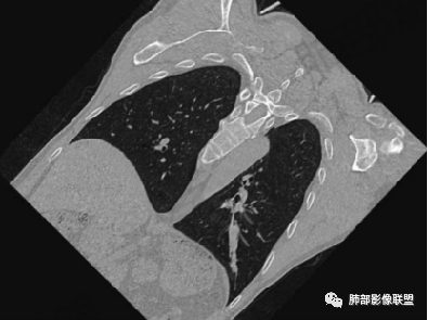 影像PPT - 周围型小细胞肺癌影像征象—条状、分支状、蠕虫样改变-11 影像PPT - 周围型小细胞肺癌影像征象—条状、分支状、蠕虫样改变-11