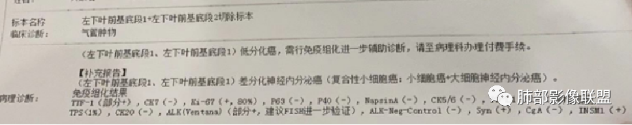 影像PPT - 周围型小细胞肺癌影像征象—条状、分支状、蠕虫样改变-12 影像PPT - 周围型小细胞肺癌影像征象—条状、分支状、蠕虫样改变-12