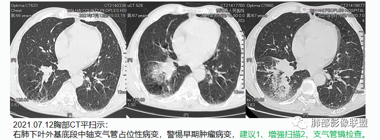 影像PPT - 周围型小细胞肺癌影像征象—条状、分支状、蠕虫样改变-16