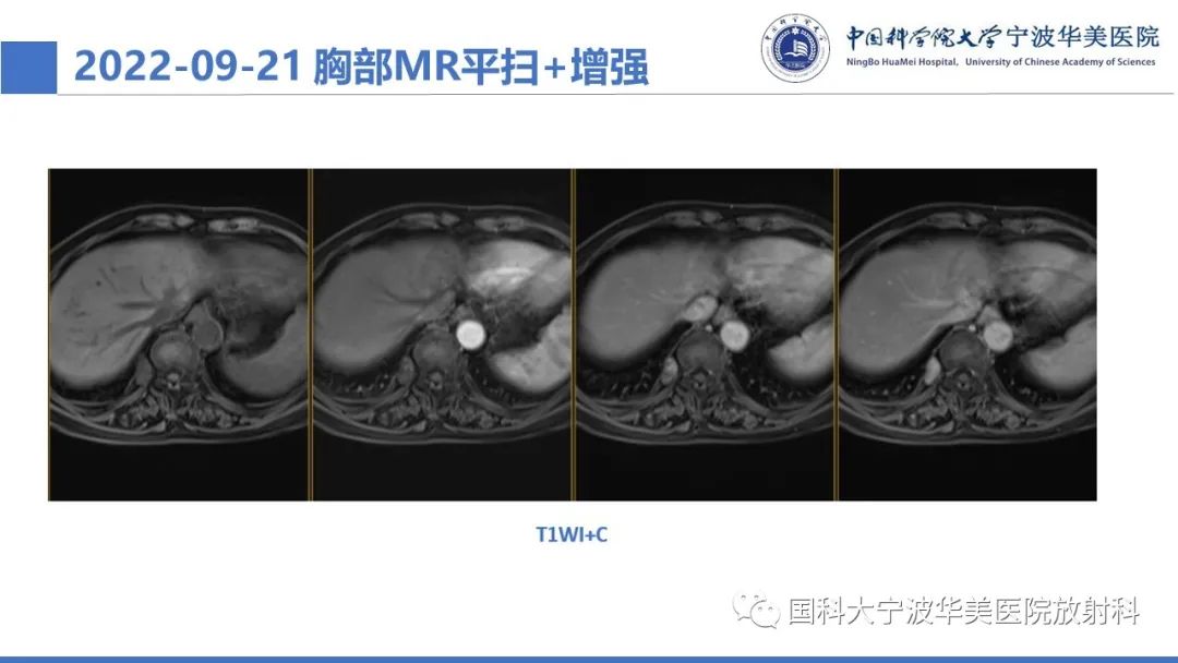 影像PPT - 【病例】纵隔海绵状血管瘤1例CT影像-5