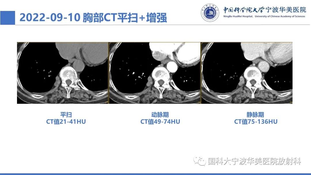 影像PPT - 【病例】纵隔海绵状血管瘤1例CT影像-3
