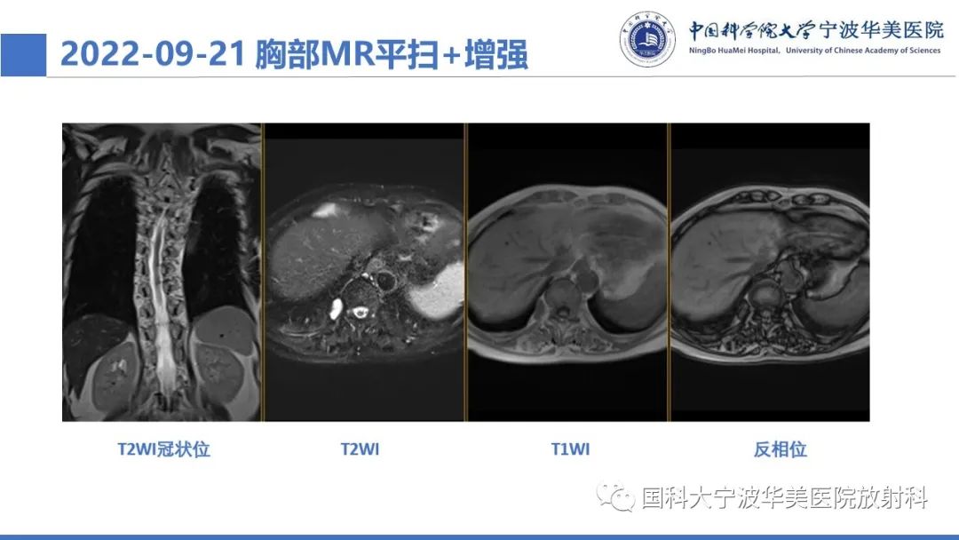影像PPT - 【病例】纵隔海绵状血管瘤1例CT影像-4