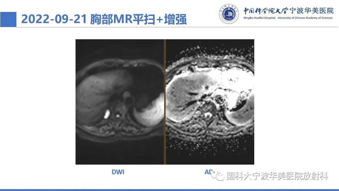影像PPT - 【病例】纵隔海绵状血管瘤1例CT影像-6