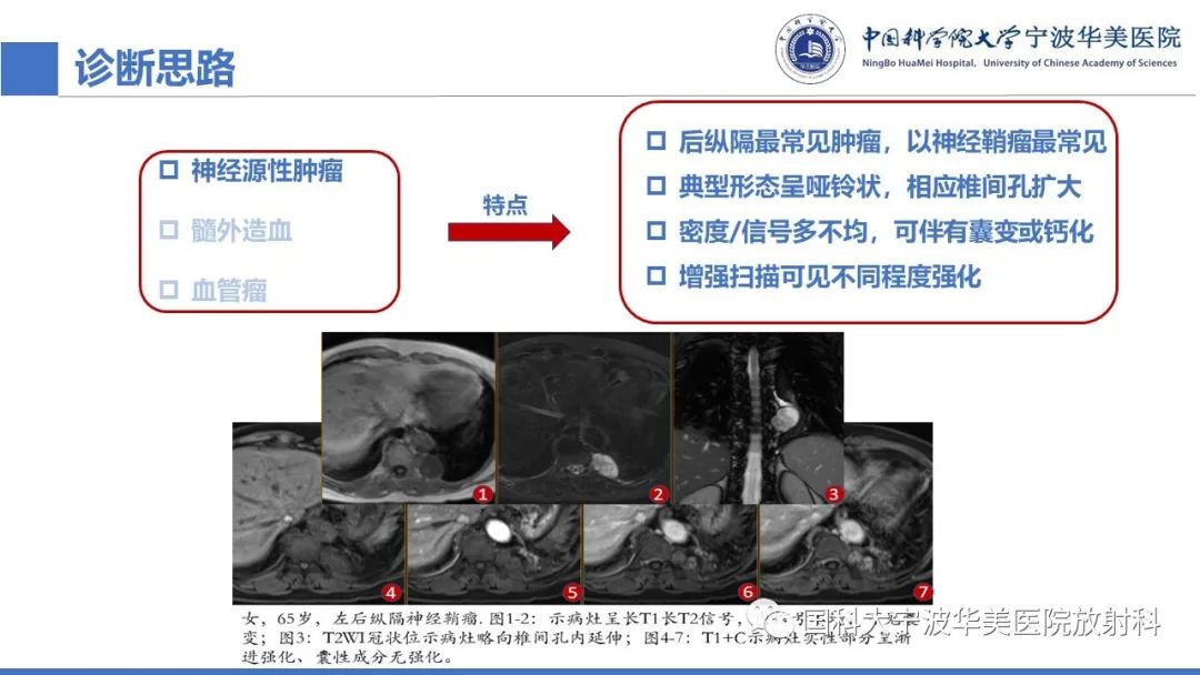 影像PPT - 【病例】纵隔海绵状血管瘤1例CT影像-8