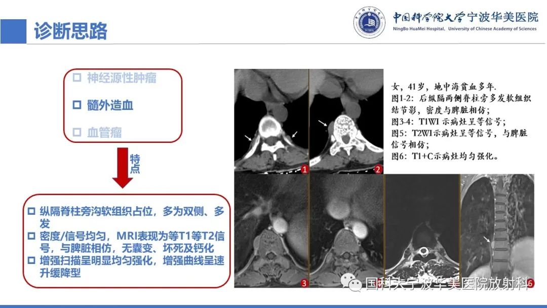 影像PPT - 【病例】纵隔海绵状血管瘤1例CT影像-9