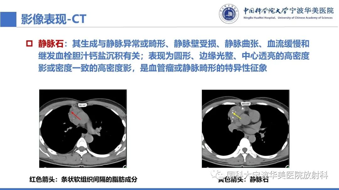 影像PPT - 【病例】纵隔海绵状血管瘤1例CT影像-17
