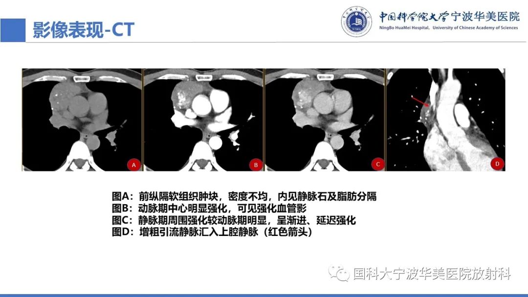 影像PPT - 【病例】纵隔海绵状血管瘤1例CT影像-19