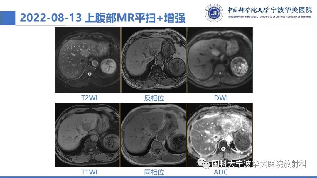 影像PPT - 【PPT】肝脏上皮样血管平滑肌脂肪瘤-4