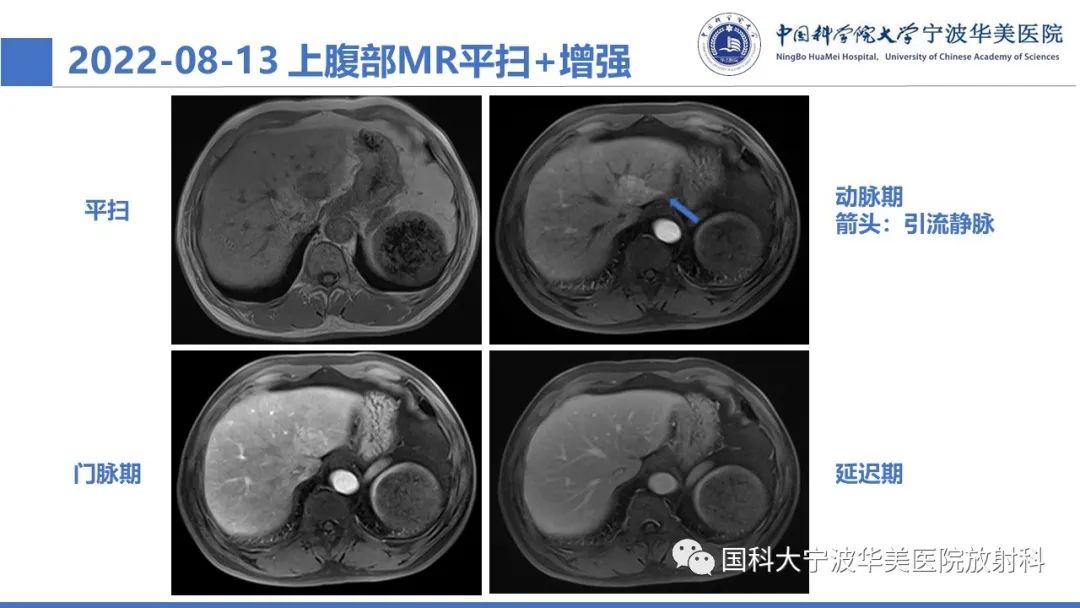 影像PPT - 【PPT】肝脏上皮样血管平滑肌脂肪瘤-5