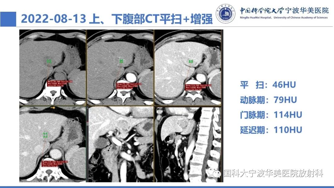 影像PPT - 【PPT】肝脏上皮样血管平滑肌脂肪瘤-6
