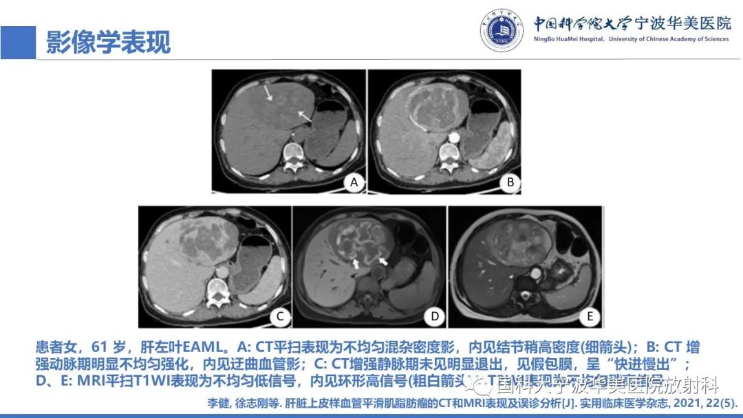 影像PPT - 【PPT】肝脏上皮样血管平滑肌脂肪瘤-19