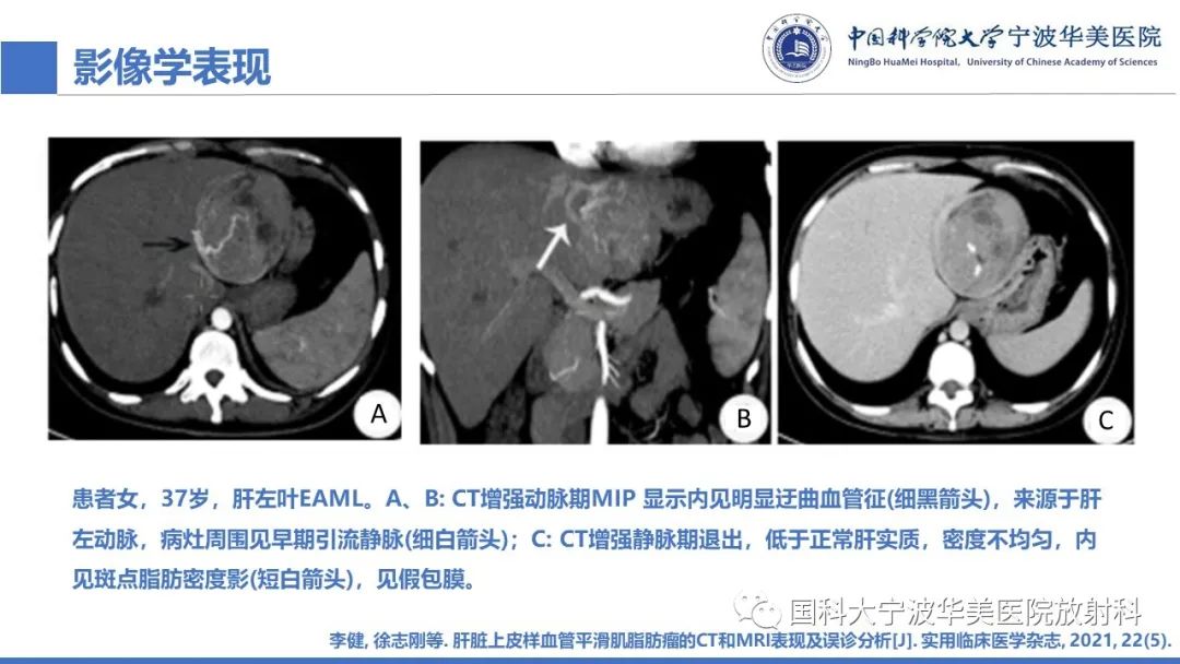 影像PPT - 【PPT】肝脏上皮样血管平滑肌脂肪瘤-20