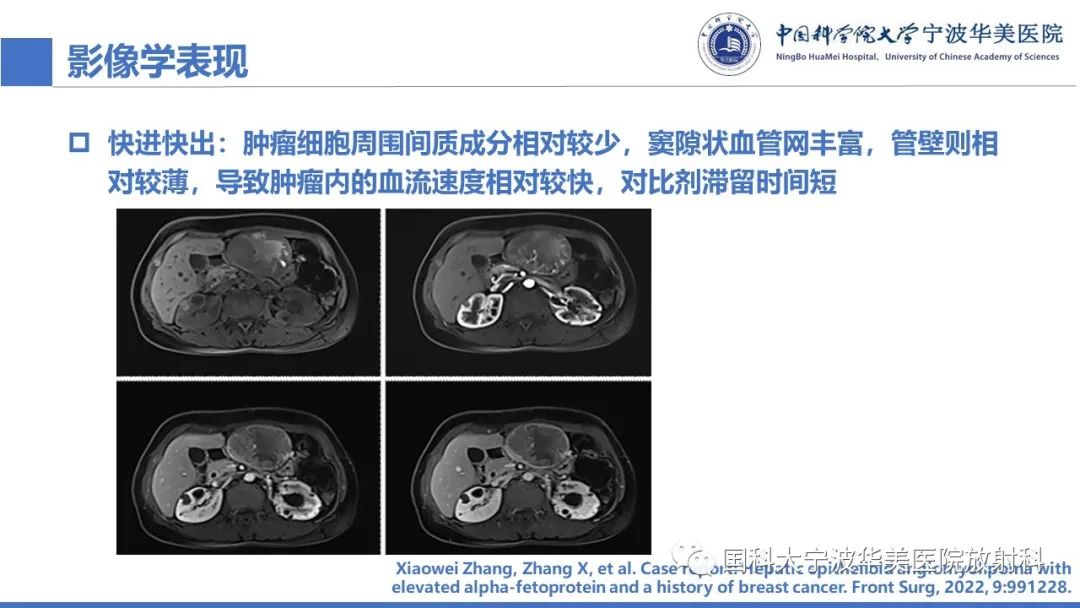 影像PPT - 【PPT】肝脏上皮样血管平滑肌脂肪瘤-21