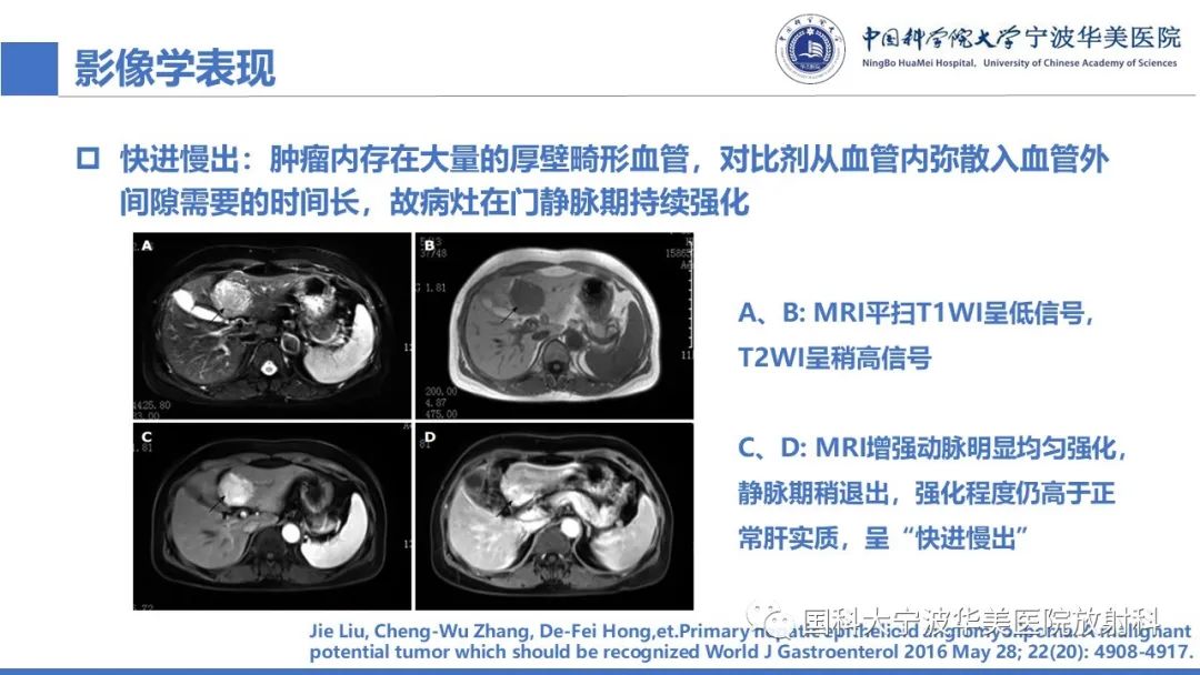 影像PPT - 【PPT】肝脏上皮样血管平滑肌脂肪瘤-22