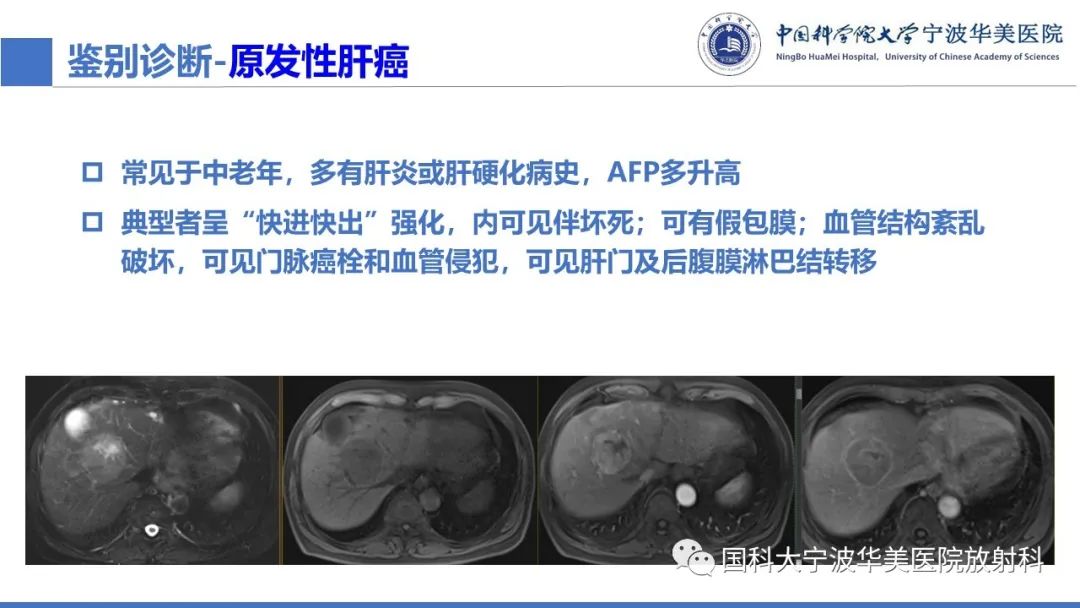 影像PPT - 【PPT】肝脏上皮样血管平滑肌脂肪瘤-24