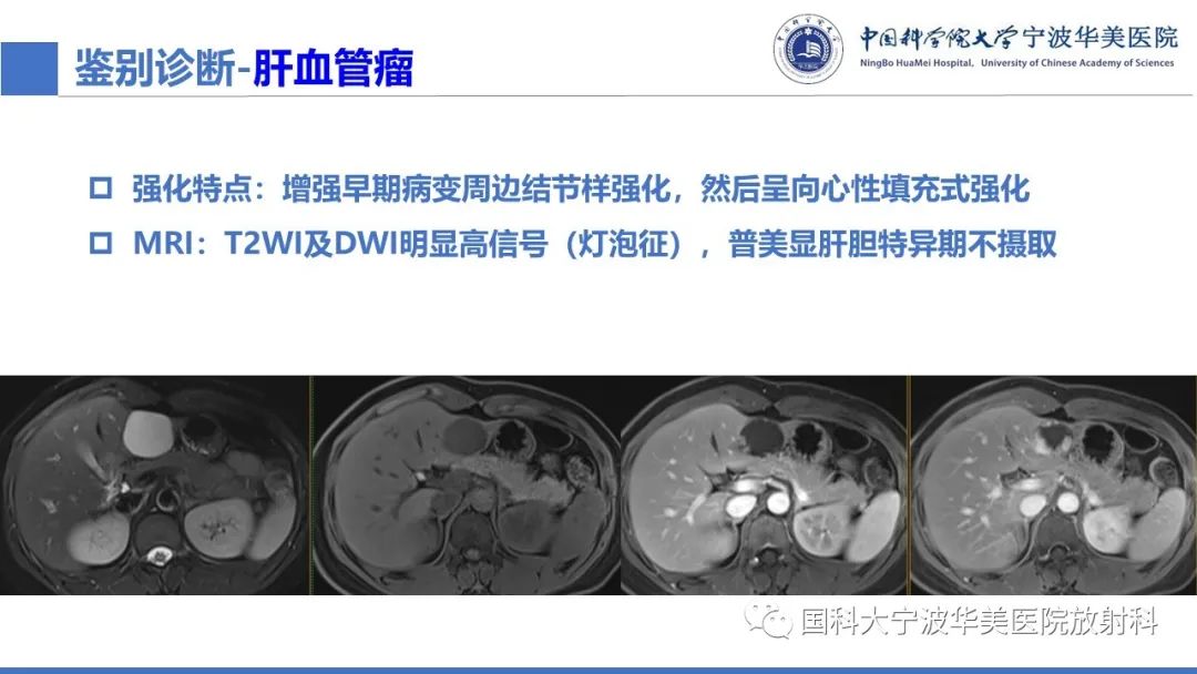 影像PPT - 【PPT】肝脏上皮样血管平滑肌脂肪瘤-25