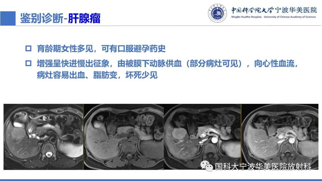 影像PPT - 【PPT】肝脏上皮样血管平滑肌脂肪瘤-26