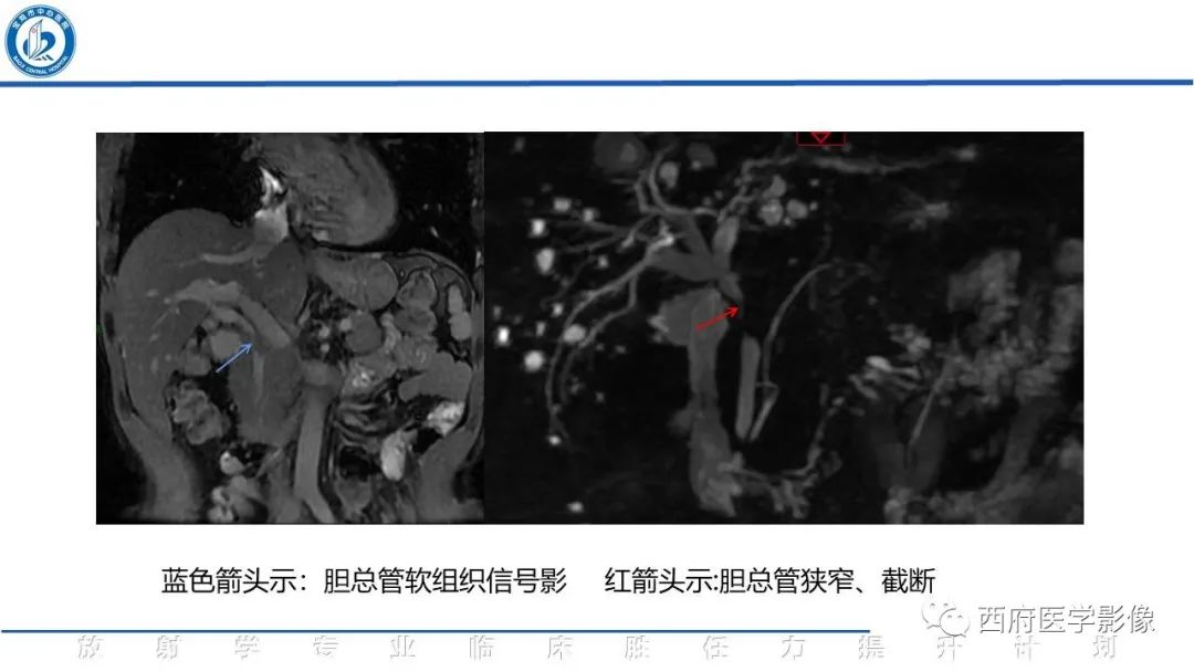 影像PPT - 【病例】胆管癌1例CT及MR影像-5