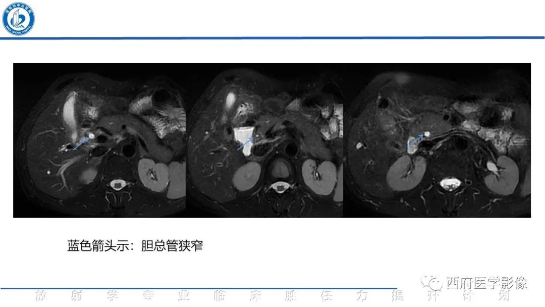影像PPT - 【病例】胆管癌1例CT及MR影像-6