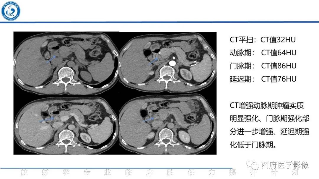 影像PPT - 【病例】胆管癌1例CT及MR影像-8