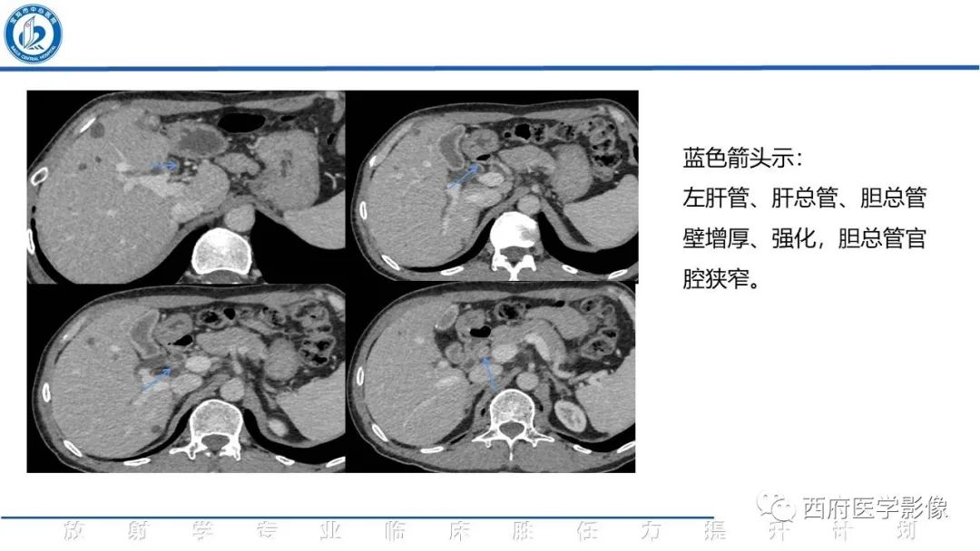影像PPT - 【病例】胆管癌1例CT及MR影像-9