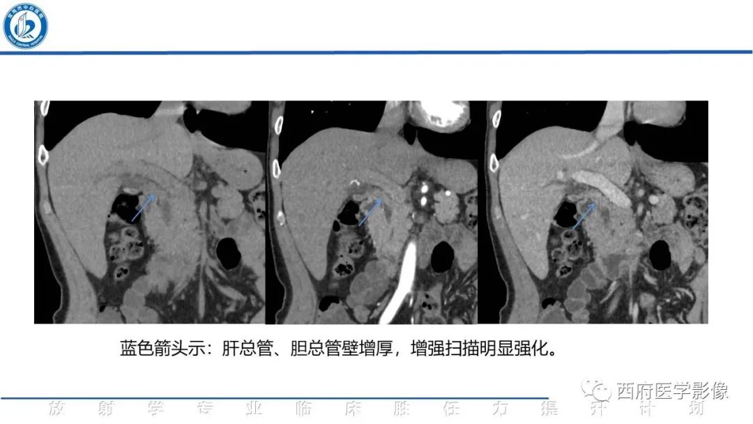 影像PPT - 【病例】胆管癌1例CT及MR影像-10