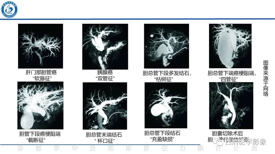 影像PPT - 【病例】胆管癌1例CT及MR影像-20