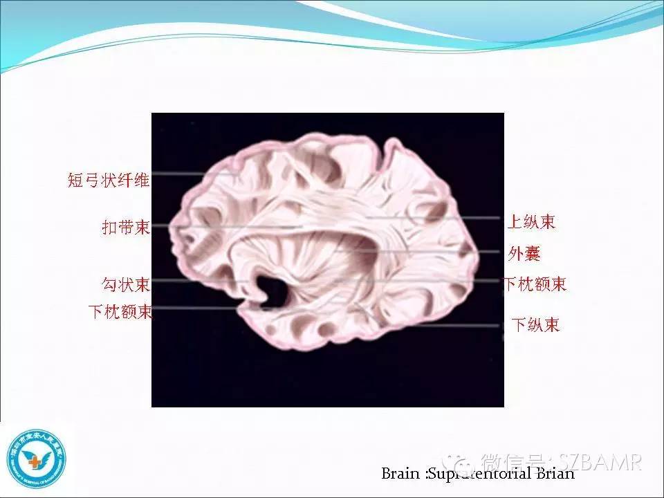 影像PPT - 【PPT】大脑白质纤维束解剖应用-9