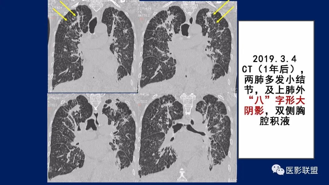 影像PPT - 【PPT】如何精准解读尘肺X片及诊断-4